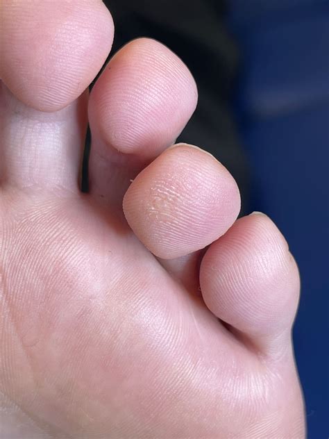 Swift Verruca Treatment - Whitley Bay | Bay Podiatry