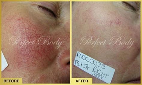 Facial Vein Removal | Perfect Body Laser
