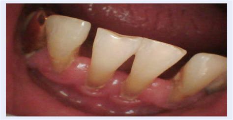 picture   gingival margin   frontal part   oral cavity