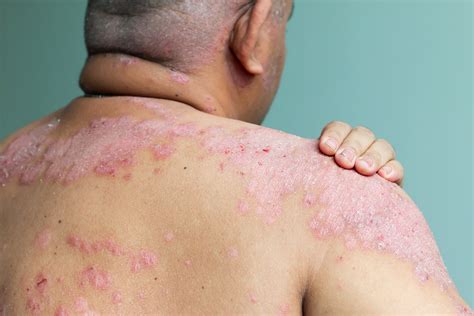 Filhos de pessoas com hanseníase podem receber pensão vitalícia ...