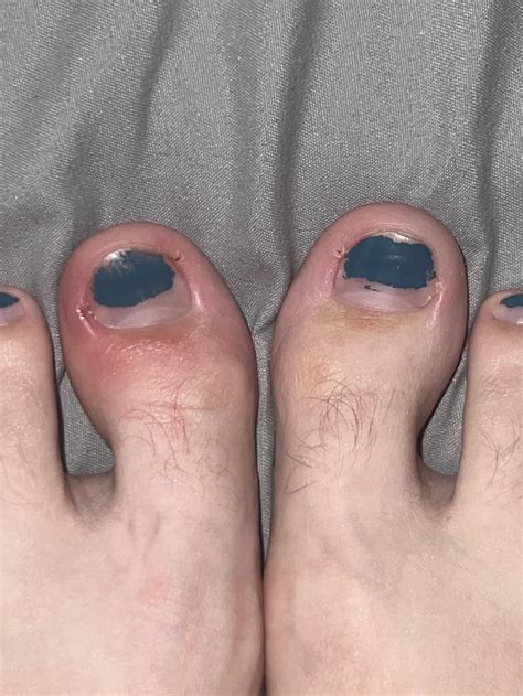is my left big toe infected? : r/Ingrown_Toenails