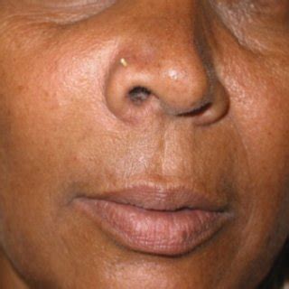 Photograph showing swelling in the right cheek | Download Scientific ...