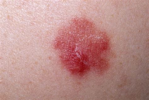 Skin Manifestations of Chronic Hepatitis C Virus Infection ...