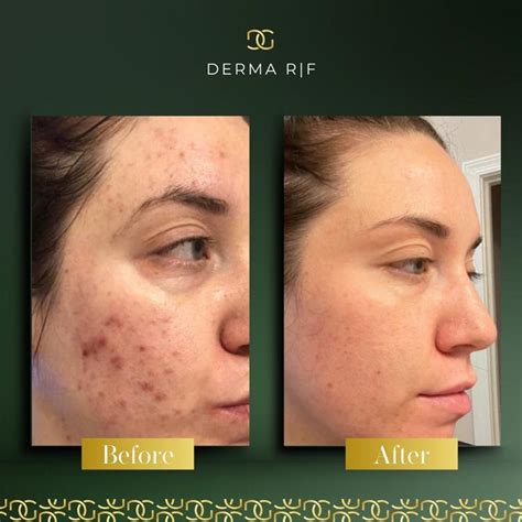 Derma Radio Frequency R|F | Derma Group Ltd