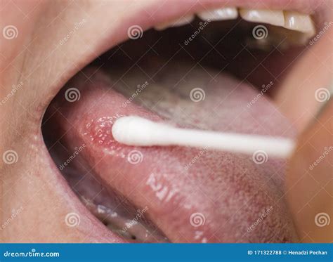 smear   disease   tongue   woman glossitis