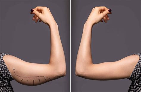 Arm Lifts - Everything You Need to Know | Dr Finkel MD