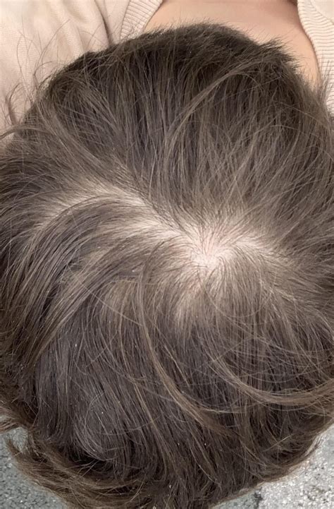 Is my hair thinning? : r/Hairloss