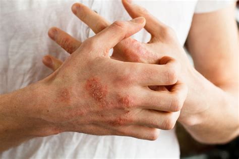 O Que É Eczema Na Pele - Eczema: o que é, sintomas, causas, tipos e tratamento - Tua Saúde