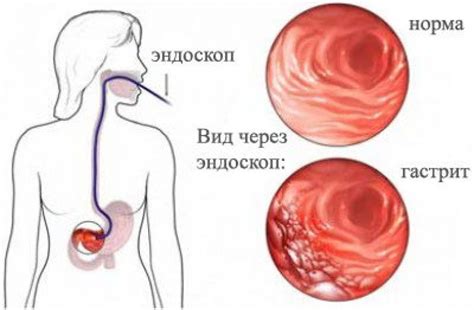 ГАСТРИТ — ПРИЧИНЫ, СИМПТОМЫ, ДИЕТА — МедВестник