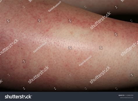 11,302 Sun Poisoning Images, Stock Photos & Vectors | Shutterstock
