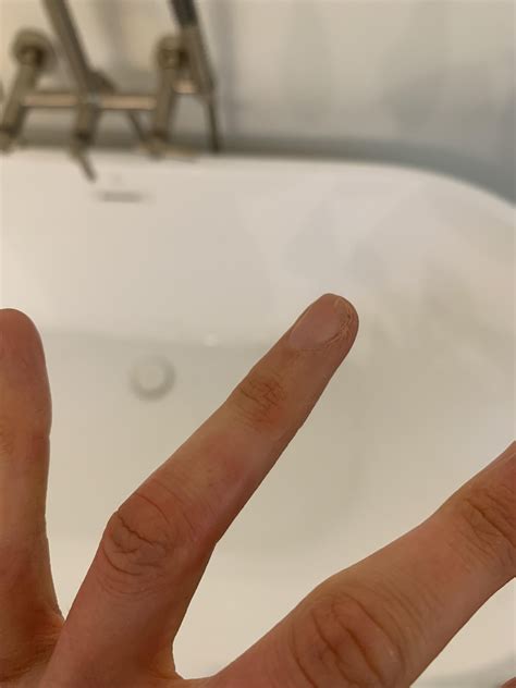 Is this a chilblain? : r/Raynauds