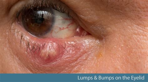 Lumps and Bumps on the Eyelid: Causes and Solutions - Illinois Eye Center