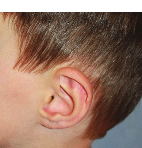 Lobeless ears in vascular Ehlers–Danlos syndrome. | Download Scientific ...