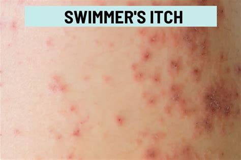 Itchy Bumps on Skin: 21 Causes, Pictures, and Treatment