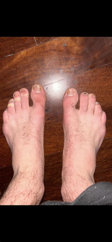 Terbinafine progress : r/NailFungus