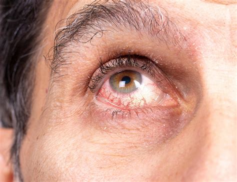 Uveitis Specialist in Houston | Clear Lake Area | CLS Health