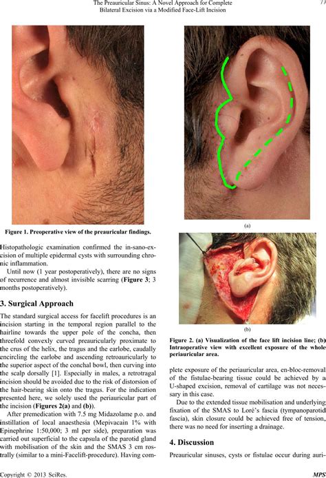 preauricular cyst excision