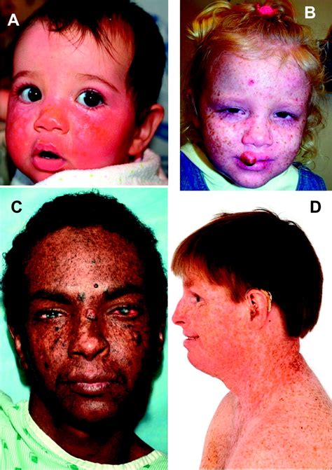 Xeroderma Pigmentosum