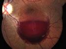 The Valsalva That Wasn’t | ophthalmologyweb.com
