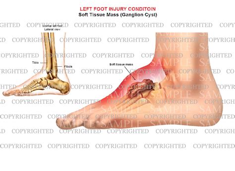 Ganglion Cyst On Foot Images Discount | emergencydentistry.com