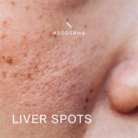 Liver Spots – NEODERMA