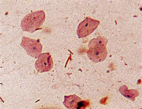 Oral Submucous Fibrosis-God's Furry or Age Old Habits?