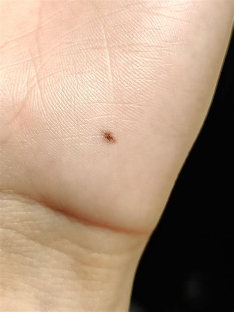 Schamberg's Disease Brown Freckle Like Spots On Feet And Ankles 6