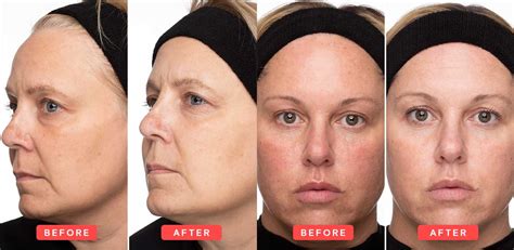 Exponent Beauty Vitamin C Serum Before and After Images | Exponent