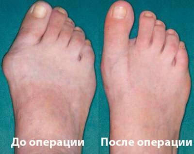 Лечение артроза стопы ног: как лечить, симптомы и степени, гимнастика