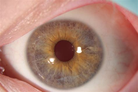 I have albinism, this is my eye : r/eyes