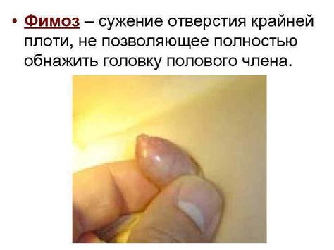 Тема 3 6 СИНДРОМ НАРУШЕНИЯ МОЧЕОТДЕЛЕНИЯ