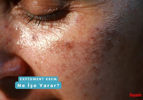Expigment Krem Ne İşe Yarar? Nasıl Kullanılır?