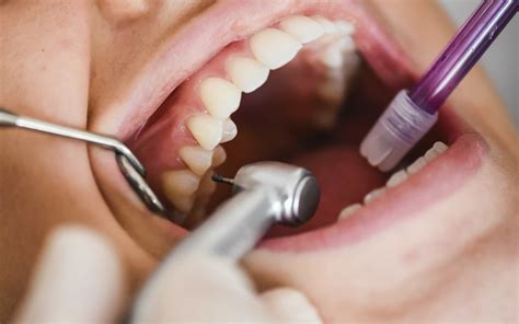 Como ocorre a formação do Cálculo Dental? | Dabi Atlante