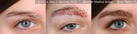 does eyebrow hair grow back 3