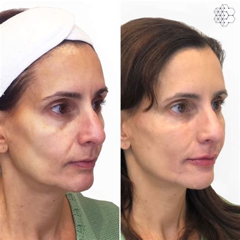 Liquid Face Lift in Vancouver, BC | Skin Technique