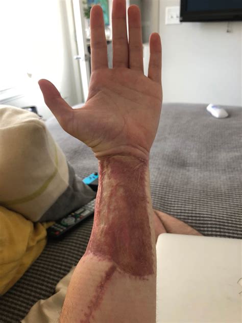 Phalloplasty Before And After Ftm