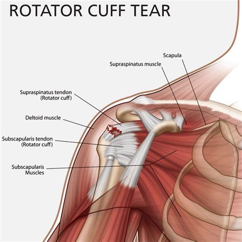 How To Fix A Shoulder Ligament Tear - Margaret Greene Kapsels