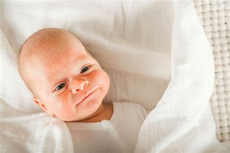 Seborrheic Dermatitis in Infants
