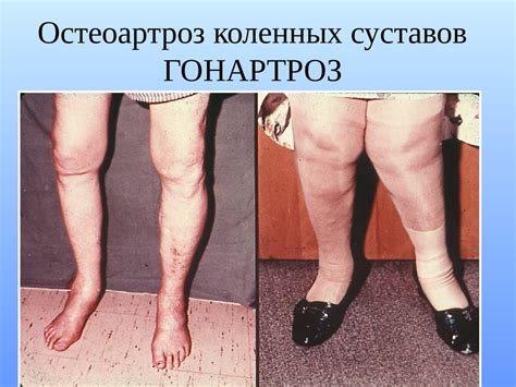 Остеоартроз (остеоартрит) - презентация онлайн