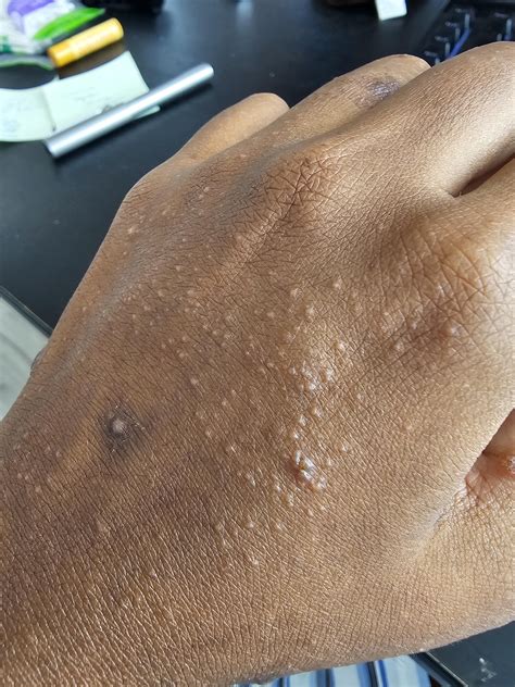 Bumps all over body : r/Autoimmune