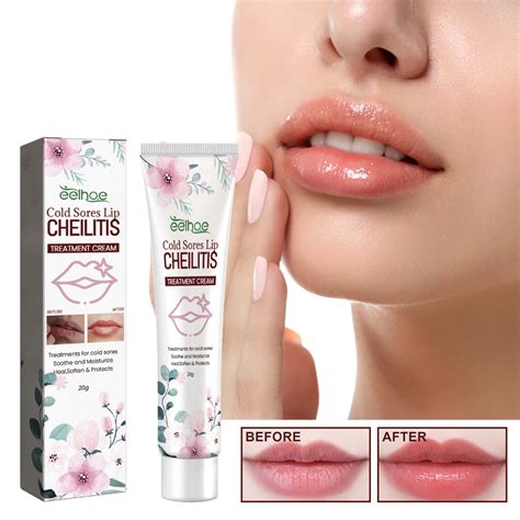 Lip Herpes Natural Treatment at Kaitlyn Guest blog