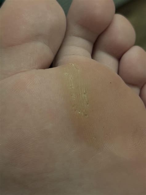 Small and painful holes on bottom of feet. What are they and how can they be treated? : r/Warts