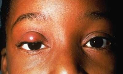 Stye and Chalazion - Riverside Eye Center