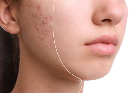 How acne scars form - Stone Oak Dermatology