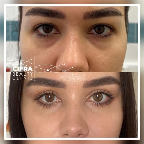 Блефаропластика в Краснодаре - Cifra Clinic