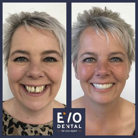 Dental Implants Leeds | Book A Free Consultation In Leeds