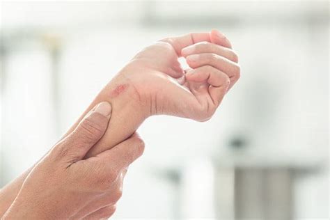 Leichte Verbrennungen – EUCERIN