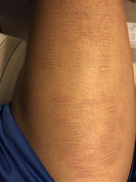 12 days clean. Really really struggling right now. : r/SelfHarmScars