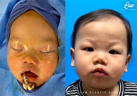 Cleft Lip Repair, Primary Unilateral Before & After Photos - Sage ...