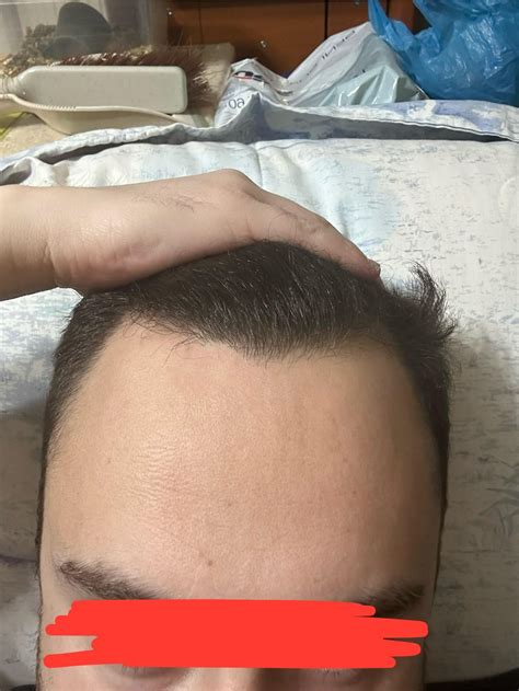 Would you do a hairline restoration in this situation with Pekiner? Not